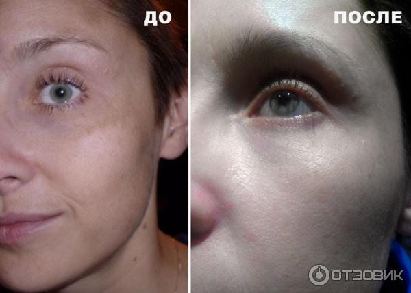 Пептиды вокруг глаз до и после фото