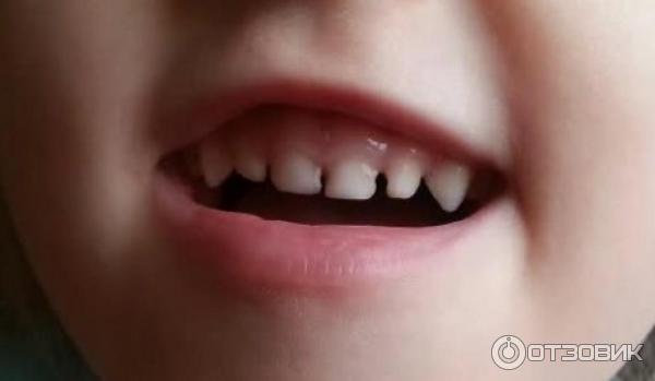 Серебрение молочных зубов Томск Дорожный 32 улыбка стоматология томск пушкина